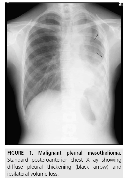 Diagnostic imaging and workup of malignant pleural mesothelioma