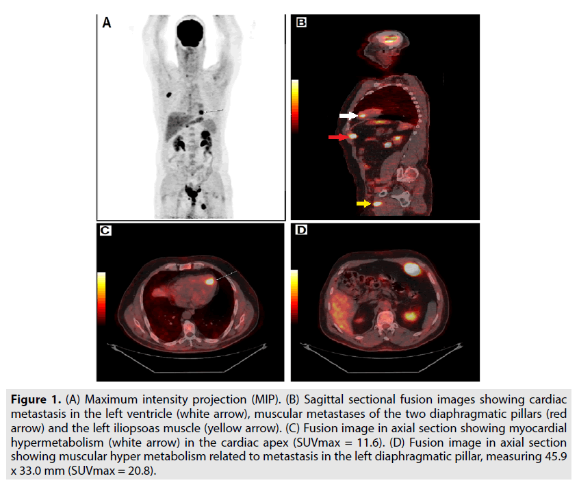 imaging-in-medicine-Maximum-intensity-projection