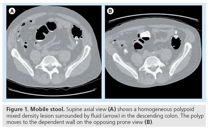 imaging-in-medicine-Mobile-stool