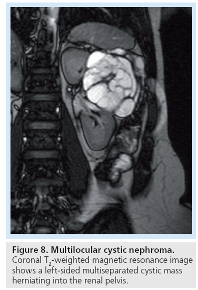 imaging-in-medicine-Multilocular-cystic