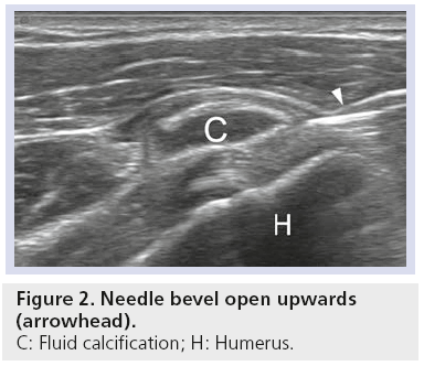 imaging-in-medicine-Needle-bevel