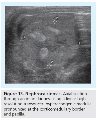 imaging-in-medicine-Nephrocalcinosis