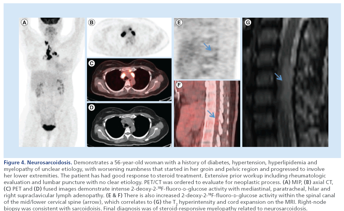 imaging-in-medicine-Neurosarcoidosis