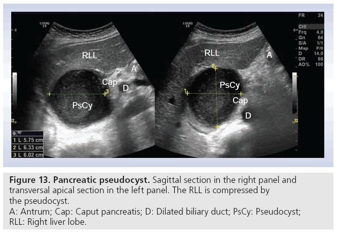 Pancreatic Pseudocyst Ultrasound Pancreatic Pseudocyst Ultrasound