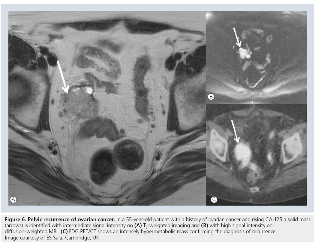 imaging-in-medicine-Pelvic-recurrence