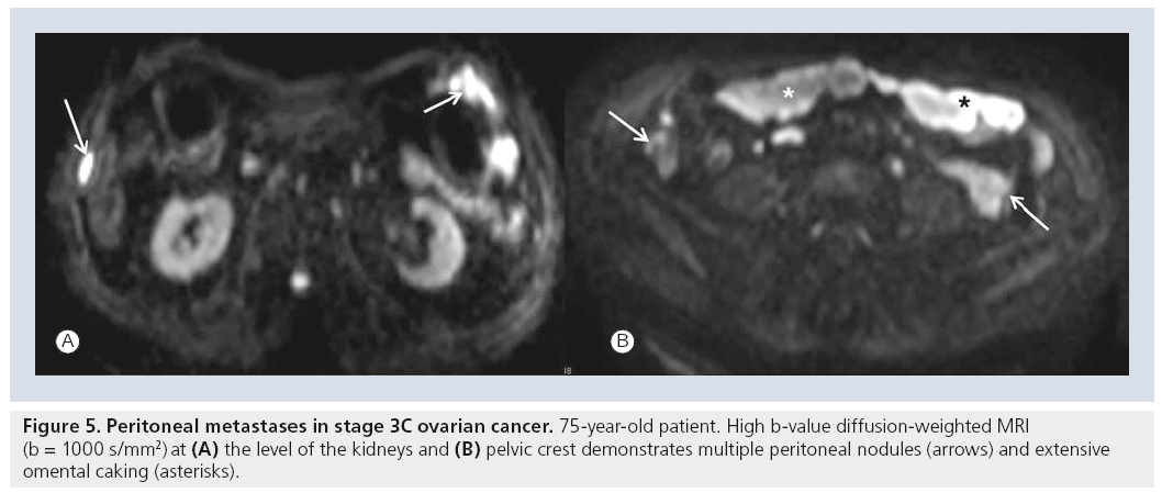 imaging-in-medicine-Peritoneal-metastases
