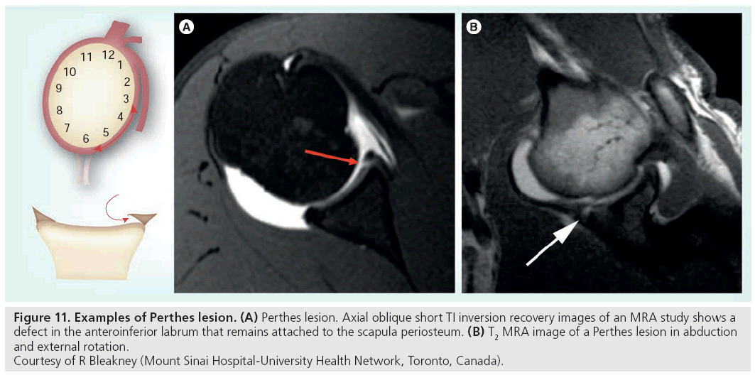 imaging-in-medicine-Perthes-lesion