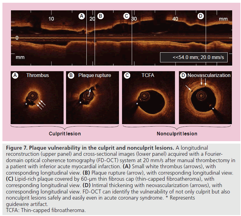 imaging-in-medicine-Plaque-vulnerability