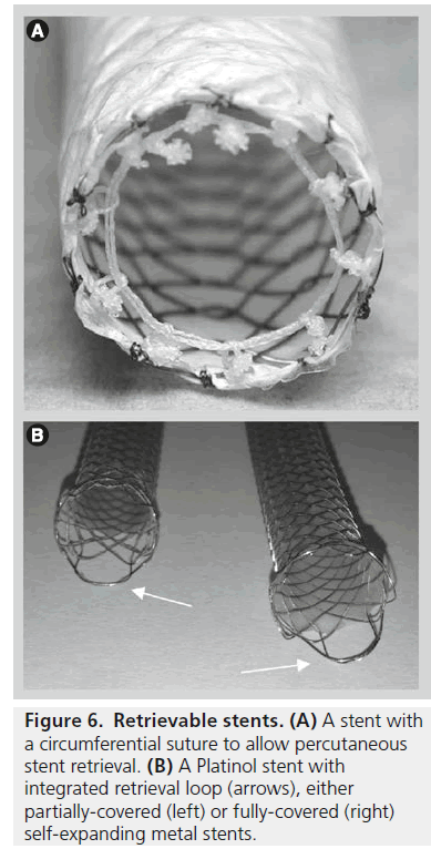 imaging-in-medicine-Platinol-stent