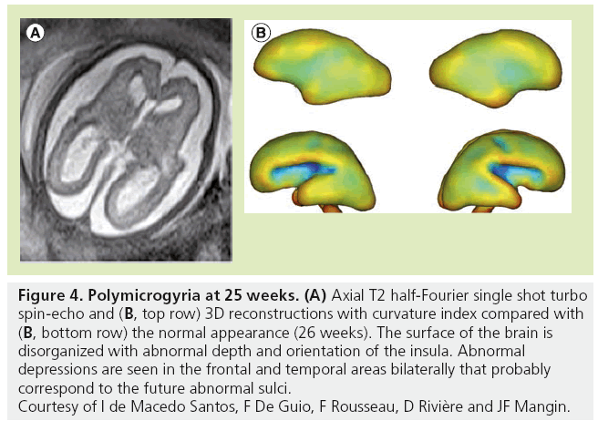 imaging-in-medicine-Polymicrogyria