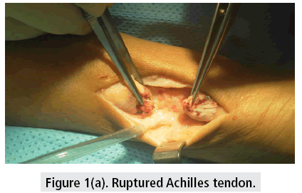imaging-in-medicine-Ruptured-Achilles