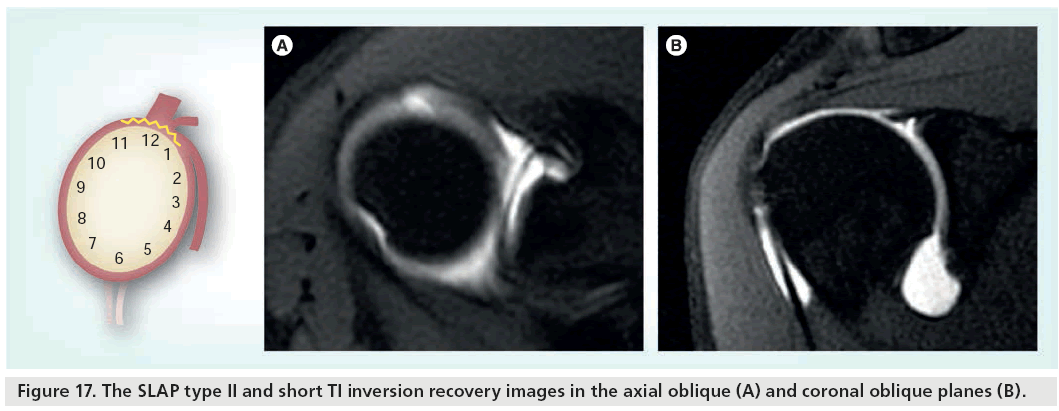 imaging-in-medicine-SLAP-type