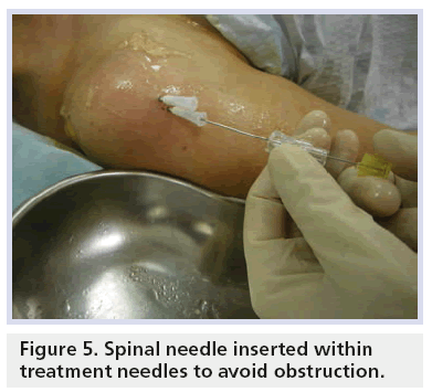 imaging-in-medicine-Spinal-needle