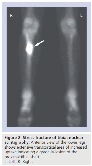 imaging-in-medicine-Stress-fracture