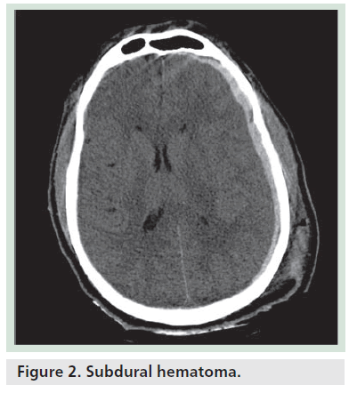 imaging-in-medicine-Subdural-hematoma