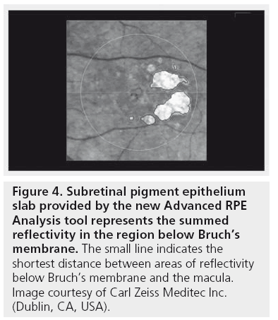 imaging-in-medicine-Subretinal-pigment