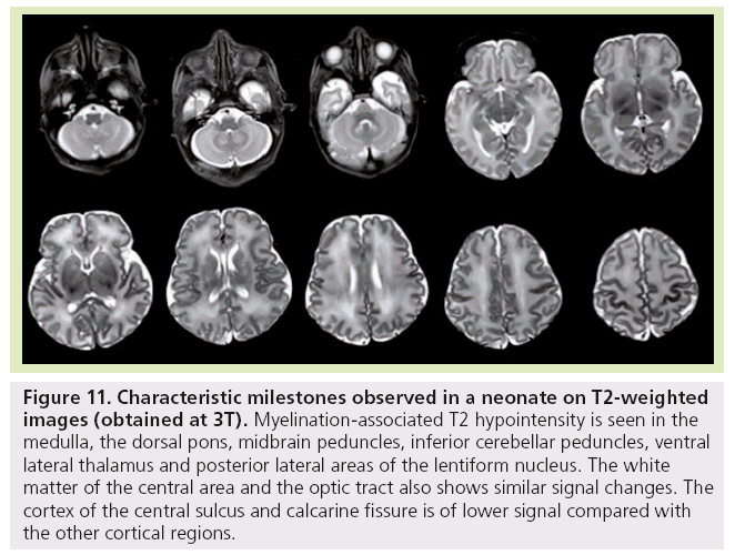 imaging-in-medicine-T2-weighted