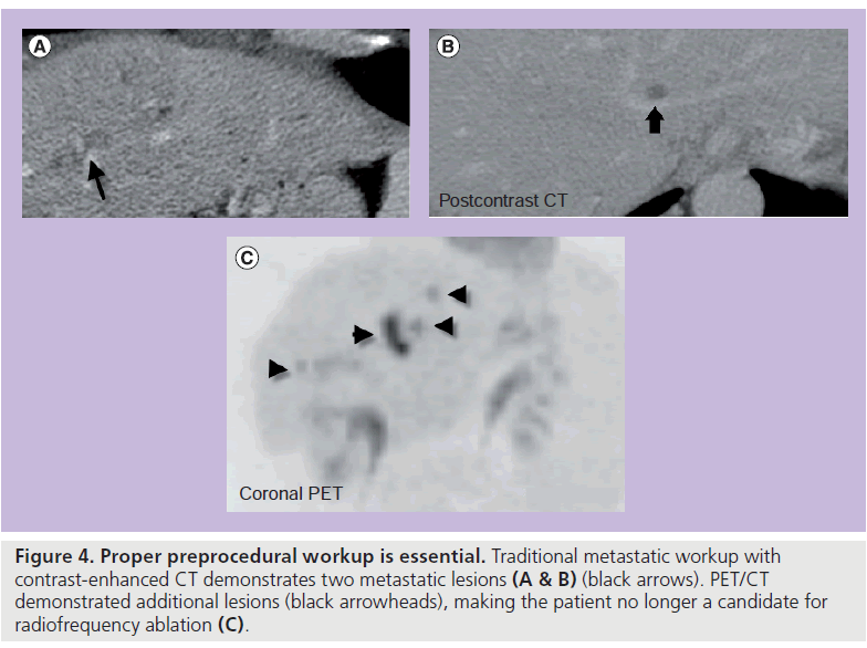 imaging-in-medicine-Traditional-metastatic