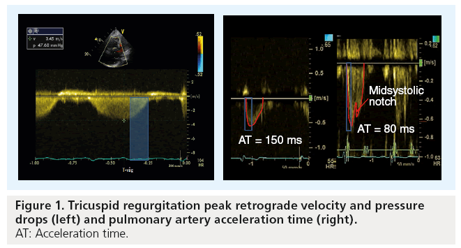 imaging-in-medicine-Tricuspid-regurgitation