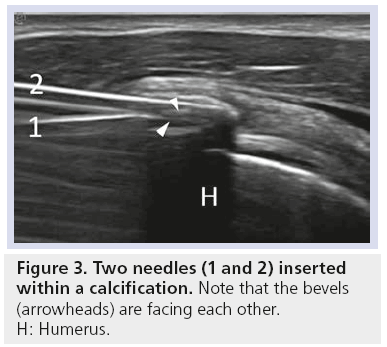 imaging-in-medicine-Two-needles
