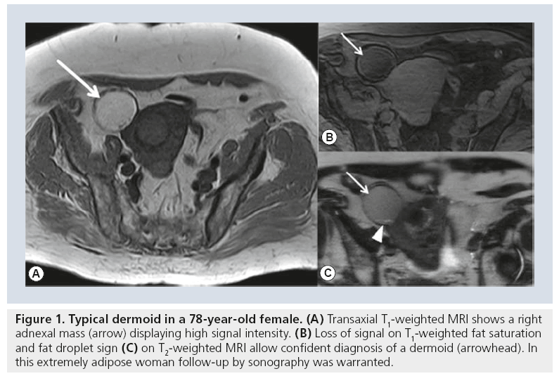 imaging-in-medicine-Typical-dermoid