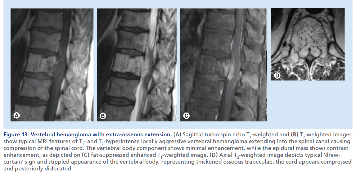 imaging-in-medicine-Vertebral–hemangioma