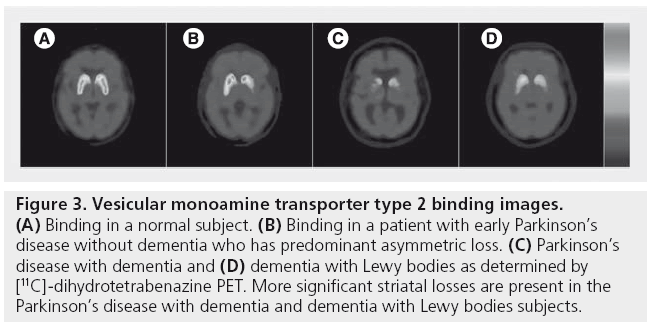 imaging-in-medicine-Vesicular-monoamine