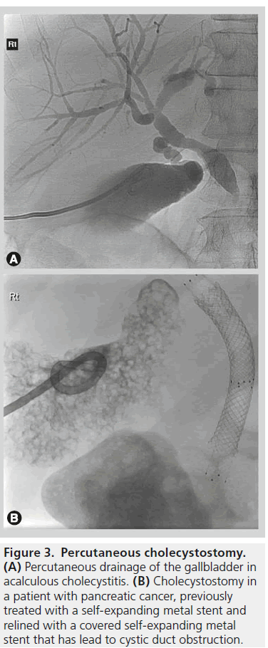 imaging-in-medicine-acalculous-cholecystitis