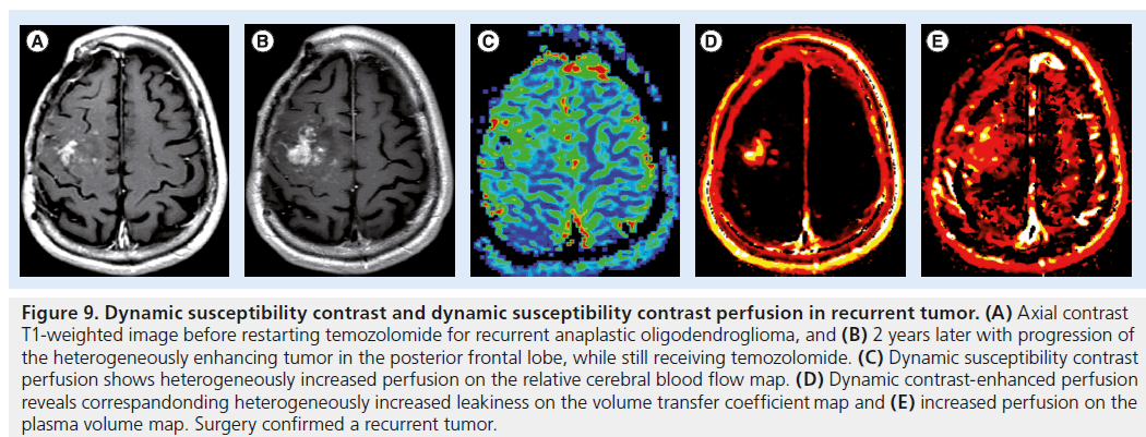 imaging-in-medicine-anaplastic-oligodendroglioma