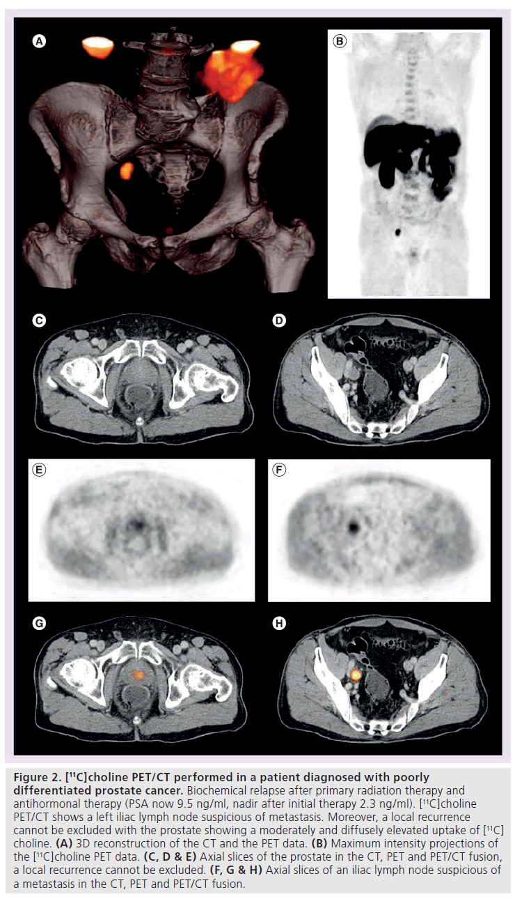 imaging-in-medicine-antihormonal-therapy