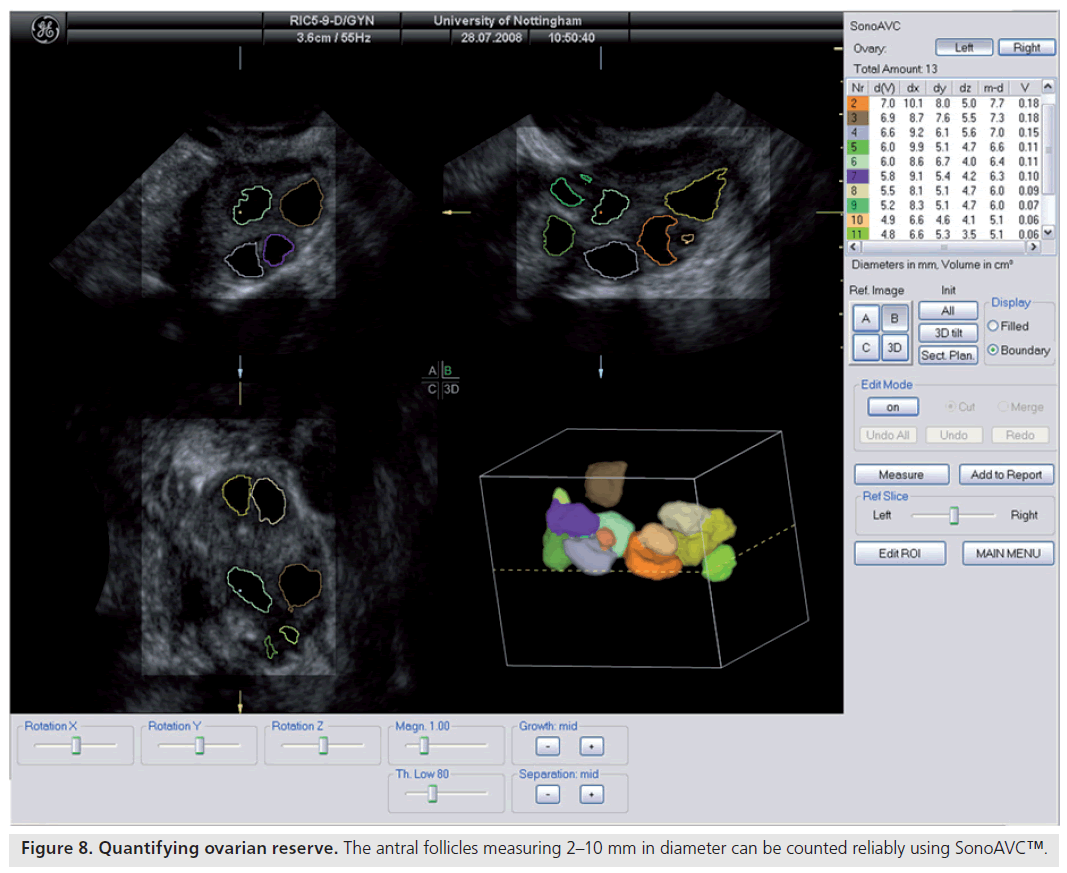 imaging-in-medicine-antral-follicles