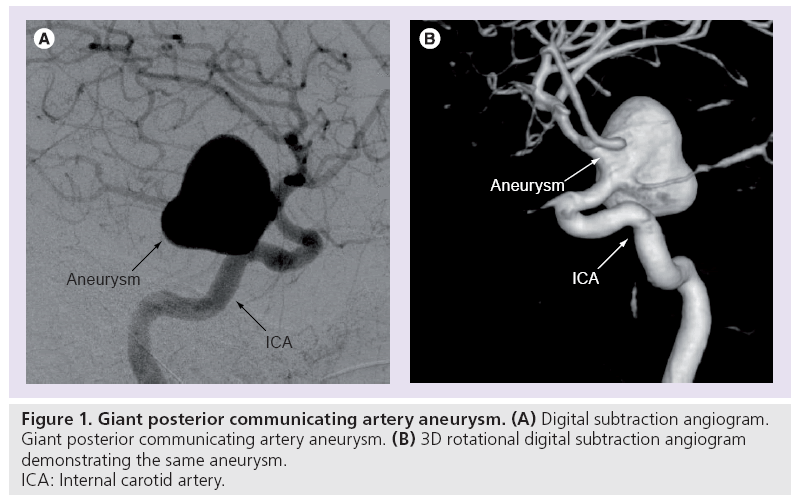imaging-in-medicine-artery-aneurysm