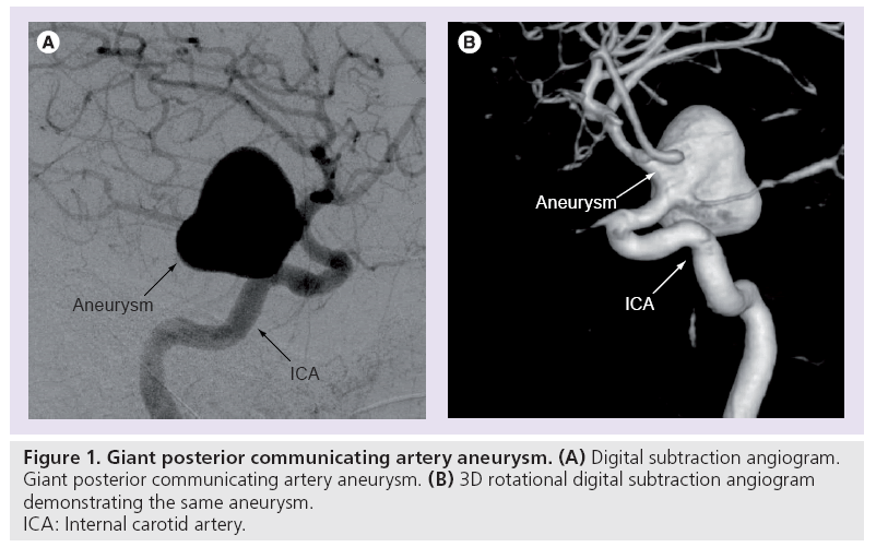 Endovascular treatment of intracranial aneurysms