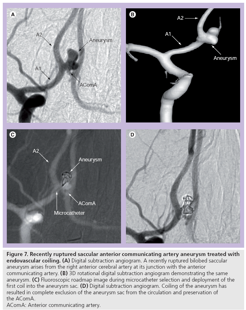 imaging-in-medicine-artery-aneurysm