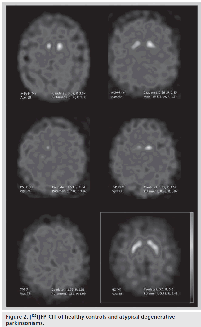 imaging-in-medicine-atypical-degenerative