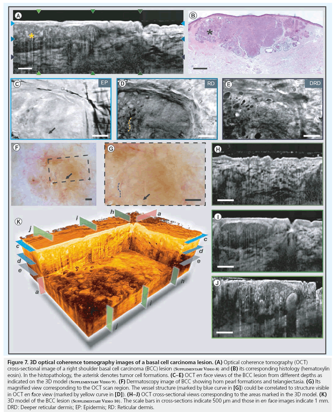 imaging-in-medicine-basal-cell