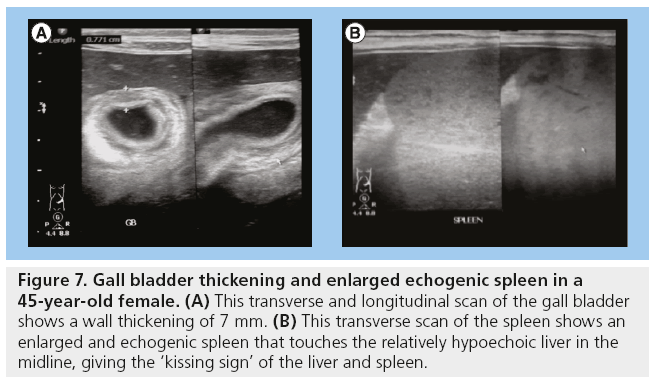 imaging-in-medicine-bladder-thickening