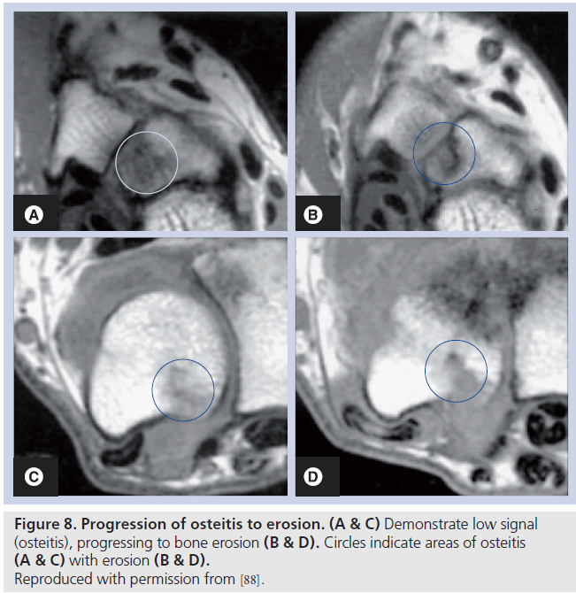 imaging-in-medicine-bone-erosion