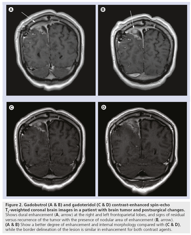 imaging-in-medicine-brain-tumor