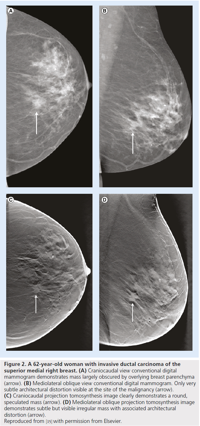 imaging-in-medicine-breast-mammogram