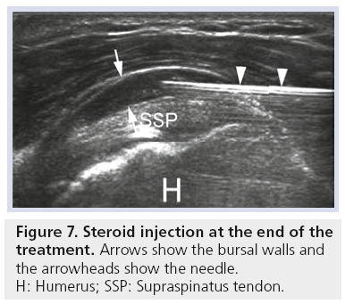 imaging-in-medicine-bursal-walls