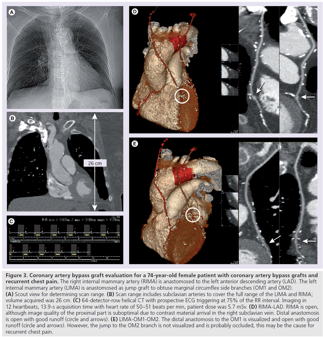 imaging-in-medicine-bypass-graft