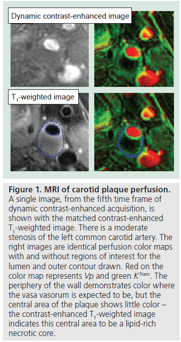 imaging-in-medicine-carotid-plaque
