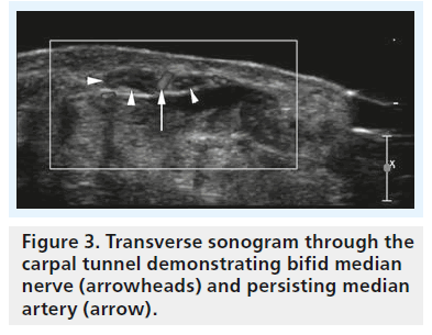 imaging-in-medicine-carpal-tunnel