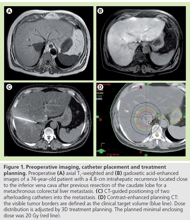 imaging-in-medicine-catheter-placement