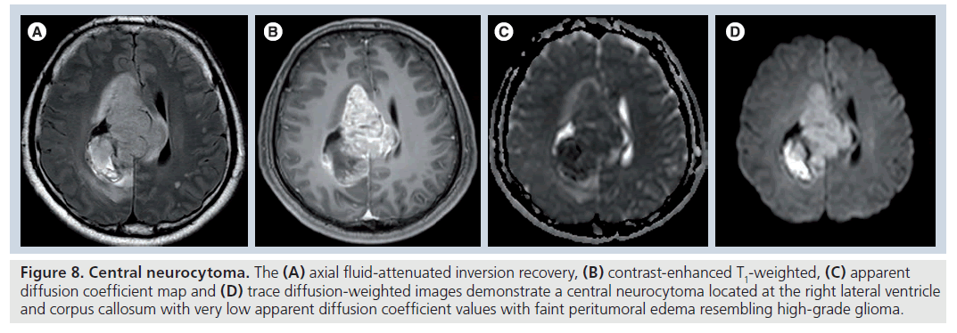 Diffusion-tensor imaging in brain tumors