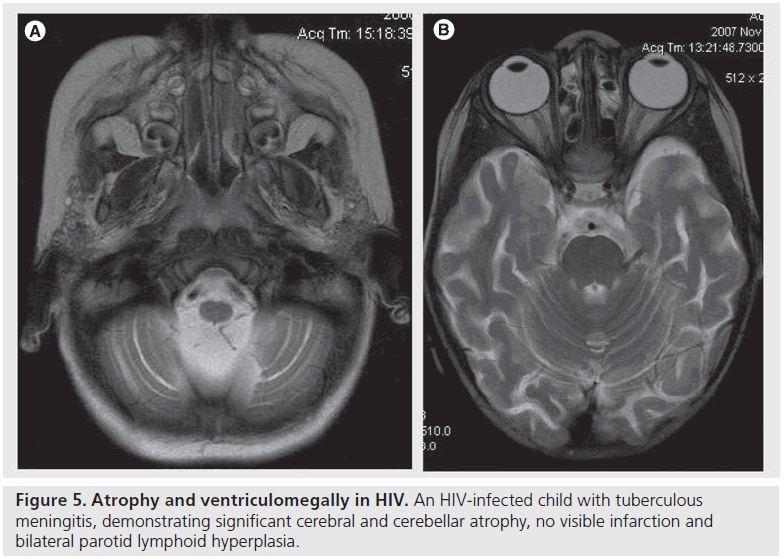 imaging-in-medicine-cerebellar-atrophy