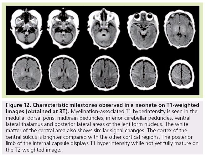 imaging-in-medicine-cerebellar-peduncles