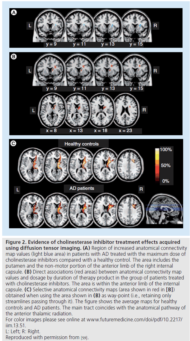 imaging-in-medicine-cholinesterase-inhibitor