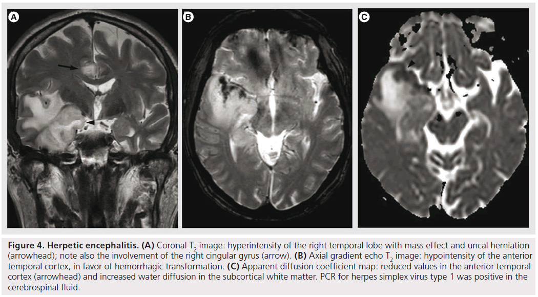 imaging-in-medicine-cingular-gyrus